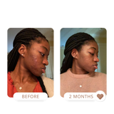 acne treatment for melanin skin. Hyperpigmentation treatment for sensitive skin. treat dermatitis and unclog pores