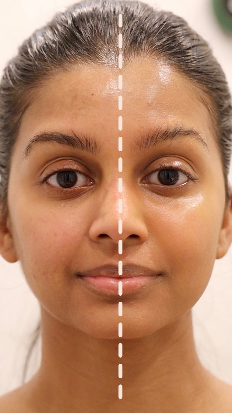 even tone skin, glowy skin, treat hyperpigmentation and heal acne